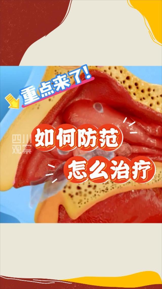 医生解读苟伟鼻息肉肥大 警惕呼吸骤停风险
